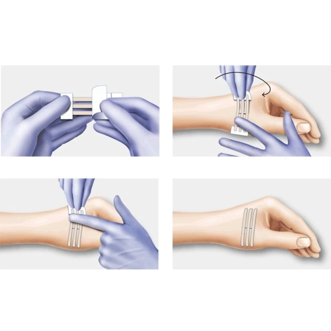 Plasturi Pentru Inlocuirea Suturilor Chirurgicale, Omnistrip, 3 X 76 MM